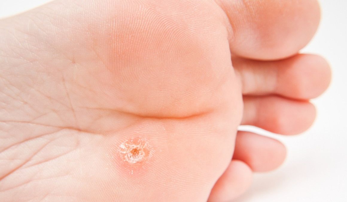5c5156050ee6949b4f349722 causas del papiloma en los pies y remedios naturales para tratarlo nzm